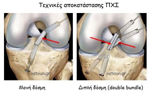 Ρήξη του προσθίου χιαστού συνδέσμου