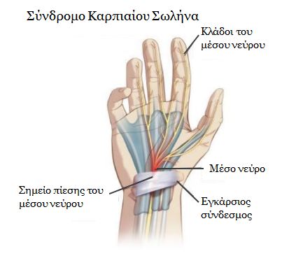 Διάνοιξη καρπιαίου σωλήνα