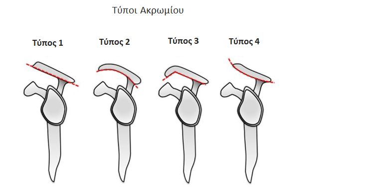 Ακρωμιοπλαστική