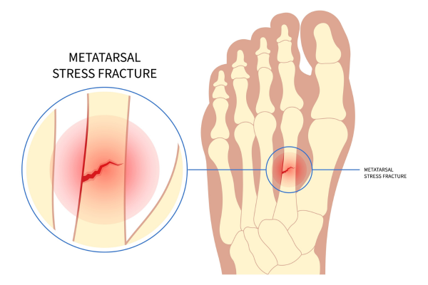 Κάταγμα κοπώσεως